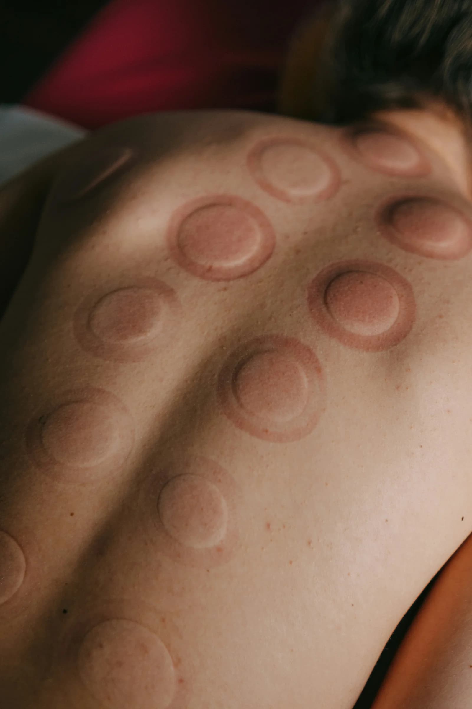 Circular cupping marks on a person's upper back in a stock photo