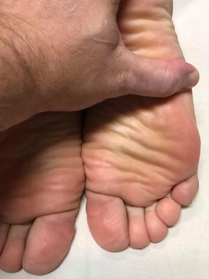 Focused thumb pressure applied to the sole of a client's foot during reflexology work